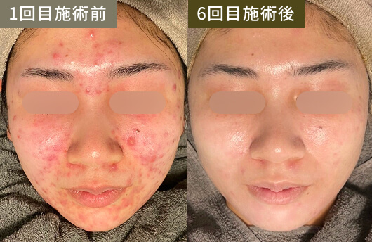 ニキビ・ニキビ跡(1回目施術前→6回目施術後)
