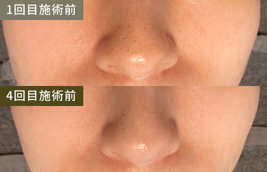 毛穴・黒ずみ(1回目施術前→4回目施術後)