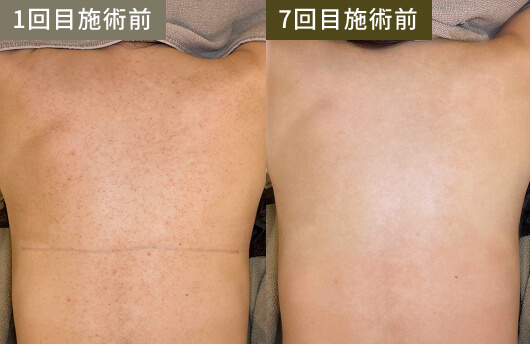 ボディケア(1回目施術前→7回目施術後)